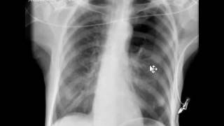 Chest xray pneumothorax [upl. by Alegna]