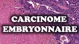 LE CARCINOME EMBRYONNAIRE – PATHOLOGIE [upl. by Annovaj]