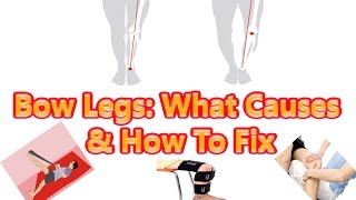 Bow Legs  What Causes How to Fix [upl. by Ainolloppa]