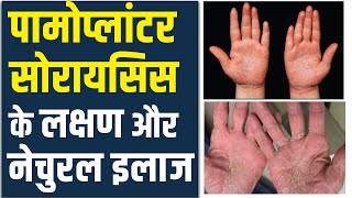 Palmoplantar Psoriasis Symptoms and Treatment Palmoplantar Psoriasis Treatment  Psoriasis Cure [upl. by Fee]