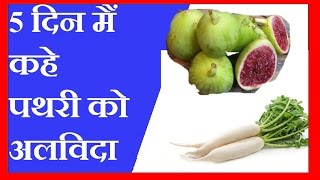 5 दिन मैं कहे पथरी को अलविदा  गुर्दे की पथरी की चमत्कारी दवाई  KIDNEY STONE HOME REMEDIES [upl. by Siloam]