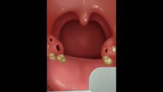 Treatment of oral gingivitis asmr shorts [upl. by Tioneb]