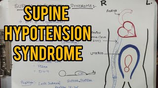 Supine Hypotension syndrome  Femoral vein Pressure  Position during pregnancy [upl. by Studley578]