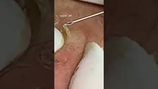 Pickel Ausdrücken Blackheads Mitesser Entfernung 🔴 61 [upl. by Anairuy]