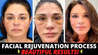 Incredible 50 Year Old Total Facial Rejuvenation Facelift eye lift lip lift fat transfer [upl. by Spalla383]