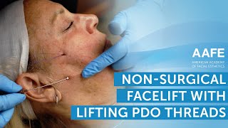 NonSurgical Facelift with Lifting PDO Threads  AAFE [upl. by Ymor784]