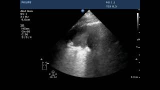 Lung POCUS  Consolidation and Hydropneumothorax [upl. by Moon548]