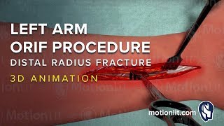 Left Arm ORIF Procedure of Distal Radius Fracture  3D Medical Animation [upl. by Pelagias]