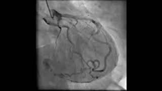 Prevalence of Congenital Coronary Artery Anomalies in Patients Undergoing Coronary Angiography [upl. by Aalst]