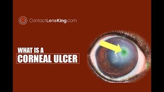 Corneal Ulcer Causes Symptoms Treatments [upl. by Nimaj]