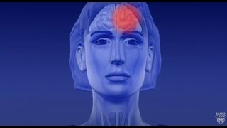 Learn About Migraine Aura [upl. by Aelber]