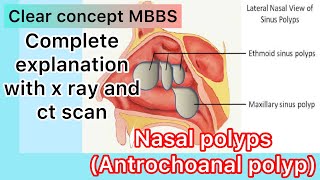 Nasal polyps Antrochoanal polyp  Complete explanation with x ray and ct scan [upl. by Anaoy]