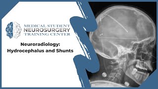 Neuroradiology Hydrocephalus and Shunts [upl. by Lorene]