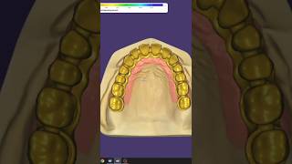 screw retained implant Bridge [upl. by Daza]