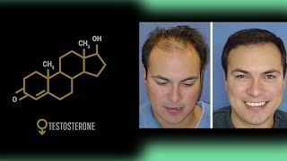 Is Testosterone Anabolic to Scalp Hair Growth [upl. by Cosetta]