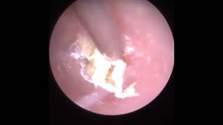 914  Dead Skin Extracted from Stenotic Ear Canal [upl. by Rabkin]