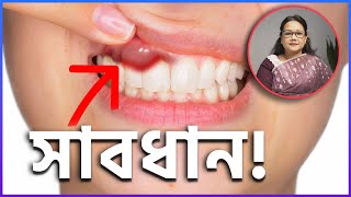 দাঁতের মাড়ি ফুলে গিয়েছে Gingivitis and its Solution [upl. by Judye69]