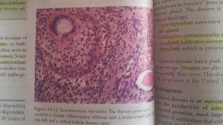 Subacute Lymphocytic and Granulomatous Thyroiditis  SPECIAL PATHOLOGY [upl. by Sokil]