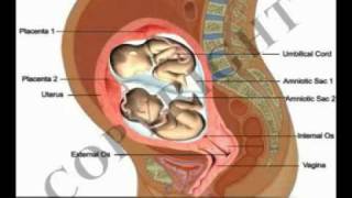 Health Video on Pregnancy Complications Twins Breech Position [upl. by Vano]