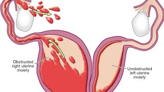 vaginafallopian tube wollfianductmullarianductvaginalseptumtransevrseseptum [upl. by Nadruoj]