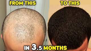 The Big 3 Hair Loss Stack HYPERRESPONDER INSANE 35 Month Results [upl. by Kannry]