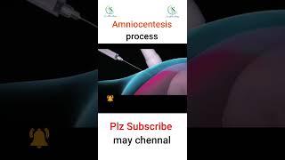 Amniocentesis process Do you know why amniocentesis is needed pregnant foryou amniocentesis [upl. by Yadahs]