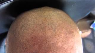 Impressie Micro Hair Pigmentation MHP behandeling bij Beauty Care Nederland BCN te Katwijk [upl. by Naman252]