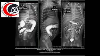 Barium Enema Procedure [upl. by Ttezil465]