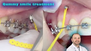 TADsmini implants to correct the gummy smile without surgery and to fix sever deep bite amp class 2 [upl. by Akinehc]