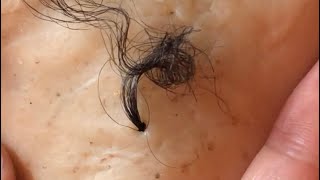 Removal of ingrown hair [upl. by Itnava]