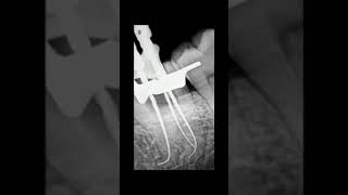 Root Canal Treatment of A curvy wisdom tooth [upl. by Eenet]