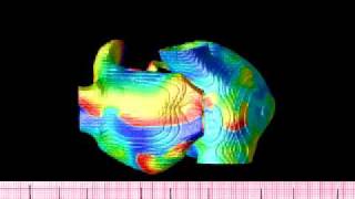 Atrial fibrillation simulation in an anatomical human atria [upl. by Aihsyn]