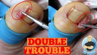 DOUBLE INGROWN TOENAIL REMOVAL FOREVERToe Nail Surgery by The Toe Bro [upl. by Yvan]