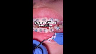 Braces mixed dentition  Orthodontic treatment in the mixed dentition Tooth Time Family Dentistry [upl. by Assylem]