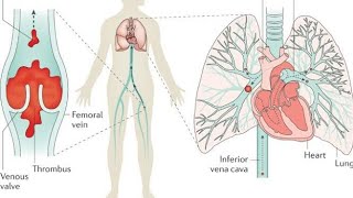 pulmonary thromboembolism1 [upl. by Nele]