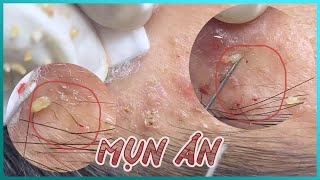 Big Cystic Acne Blackheads Extraction Blackheads amp Milia Whiteheads Removal Pimple Popping [upl. by Suolhcin]