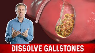 What Causes Gallstones amp How to Treat Them – DrBerg [upl. by Acireed]