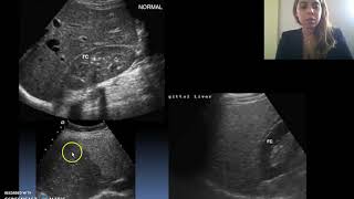 Ecografía de Hígado y Vesícula [upl. by Geirk]