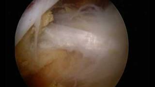 UK Surgeon  wwwshouldersurgeryorguk  Arthroscopic Suprascapular nerve decompression [upl. by Brunn262]