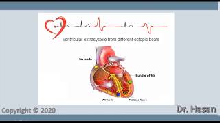 Extrasystole  Premature contraction  atrial nodal and ventricular extrasystole [upl. by Boote]