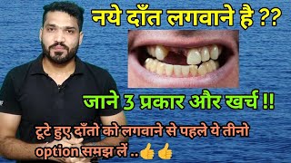 नये दाँत लगवाने के 3 प्रकार और खर्च  Three Teeth replacement options and cost [upl. by Henigman271]