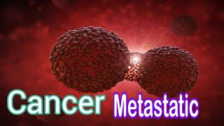 Cancer Metastatic  کینسر کا پھیلاؤ [upl. by Rodablas]