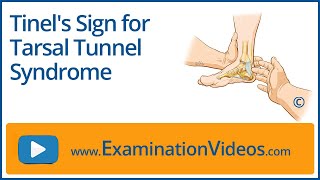 Tinels Sign for Tarsal Tunnel Syndrome [upl. by Schulman]