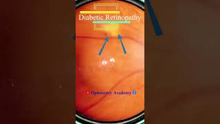 Diabetic retinopathy  cotton wool spots  Fundus  Short Video 172 optometryacademy akleshkumar [upl. by Patterman]