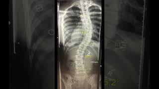 6 months of the nonsurgical ASMI treatment for Scoliosis [upl. by Nillor118]