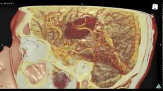 intracerebral hemorrhage：脳内出血 [upl. by Studley]