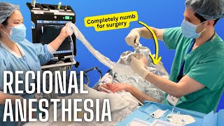 How anesthesiologists numb specific body parts actual video of a nerve block [upl. by Lrem342]