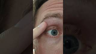 OneEyed Willy Stab cyst pop [upl. by Fernas224]