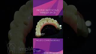 PRÓTESE PROTOCOLO SOBRE IMPLANTE DENTÁRIO COM COMPUTAÇÃO GRAFICA E IMPRESSORA 3D  Clínica ImplArt [upl. by Ariaet]