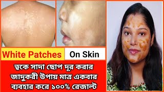 how to remove skin white patch। ছুলি বা ত্বকের সাদা ছোপ দূর করার জাদুকরী উপায়।১০০ কার্যকরী [upl. by Allene]